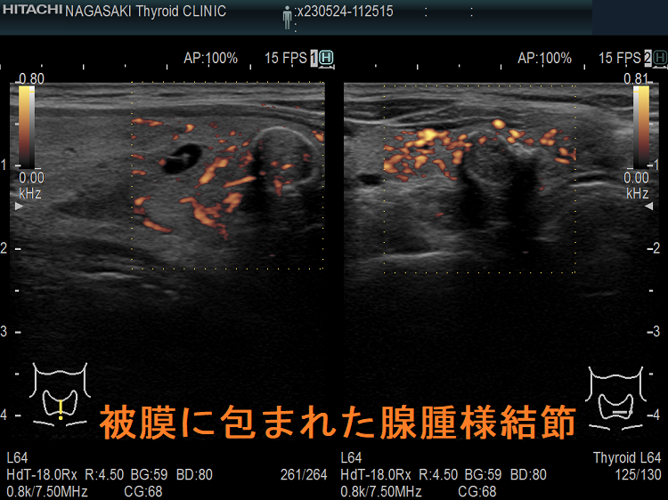 例外的に被膜に包まれた腺腫様結節 超音波(エコー)画像 ドプラーモード 例外的に被膜に包まれた腺腫様結節 超音波(エコー)画像 ドプラーモード