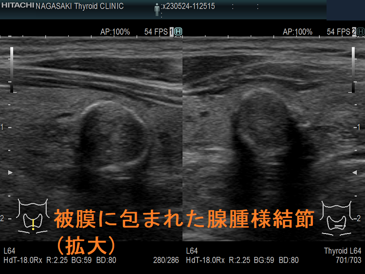例外的に被膜に包まれた腺腫様結節 超音波(エコー)画像 (拡大) 例外的に被膜に包まれた腺腫様結節 超音波(エコー)画像 (拡大)