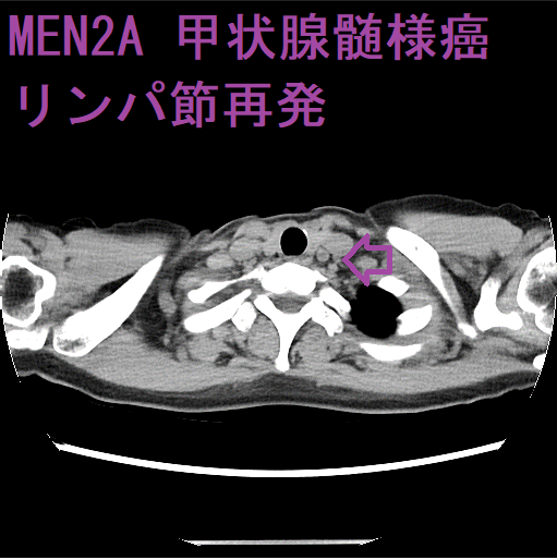 MEN2A 甲状腺髄様癌リンパ節再発 単純CT画像 MEN2A 甲状腺髄様癌リンパ節再発 単純CT画像