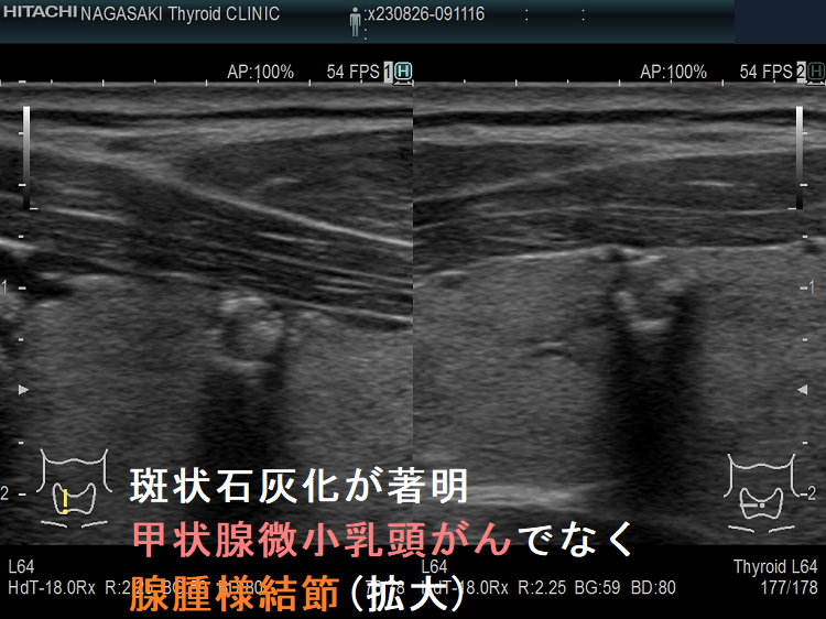 斑状石灰化が著明 甲状腺微小乳頭がんでなく腺腫様結節(拡大) 斑状石灰化が著明 甲状腺微小乳頭がんでなく腺腫様結節(拡大)