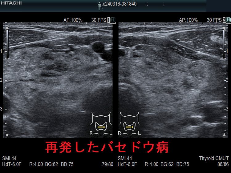 再発したバセドウ病 超音波(エコー)画像 再発したバセドウ病 超音波(エコー)画像