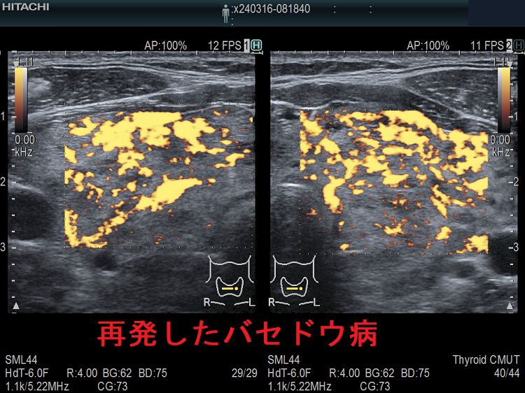 再発したバセドウ病 超音波(エコー)画像 ドプラーモード 再発したバセドウ病 超音波(エコー)画像 ドプラーモード