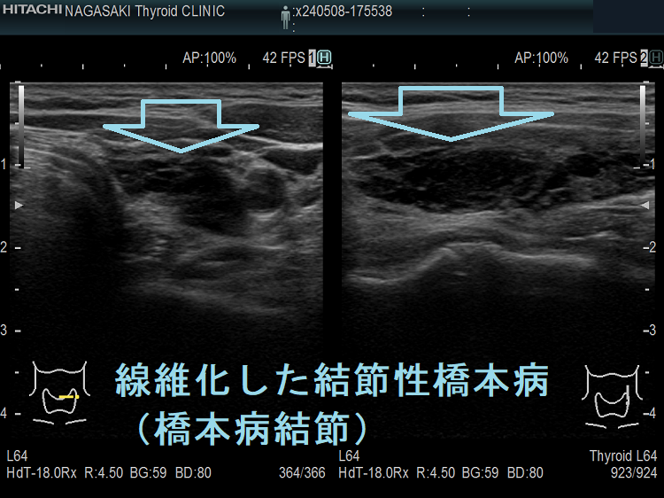 線維化した結節性橋本病(橋本病結節) 線維化した結節性橋本病(橋本病結節)