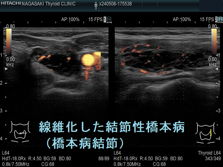 線維化した結節性橋本病(橋本病結節)ドプラーモード 線維化した結節性橋本病(橋本病結節)ドプラーモード