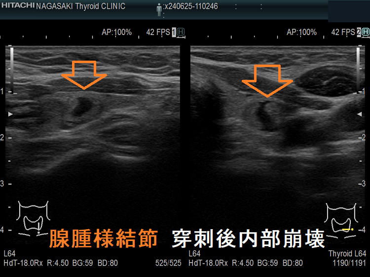 腺腫様結節 穿刺後内部崩壊 腺腫様結節 穿刺後内部崩壊