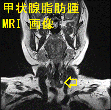 甲状腺脂肪腫 MRI 画像 甲状腺脂肪腫 MRI 画像