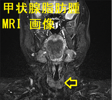甲状腺脂肪腫 MRI 画像 甲状腺脂肪腫 MRI 画像2