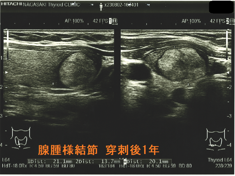 腺腫様結節 穿刺後著明縮小 穿刺後1年 腺腫様結節 穿刺後著明縮小 穿刺後1年