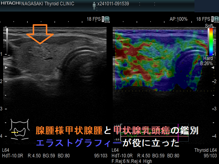 よし様 エコー 超音波(エコー)検査での腺腫様甲状腺腫・腺腫様結節と甲状腺乳頭