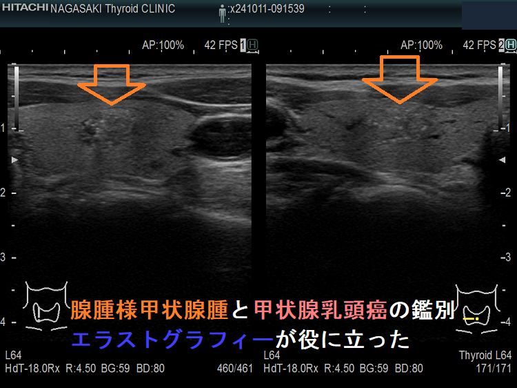 腺腫様甲状腺腫と甲状腺乳頭癌の鑑別 エラストグラフィーが役に立った 腺腫様甲状腺腫と甲状腺乳頭癌の鑑別 エラストグラフィーが役に立った