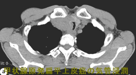 甲状腺原発扁平上皮癌の気管浸潤 CT画像 甲状腺原発扁平上皮癌の気管浸潤 CT画像