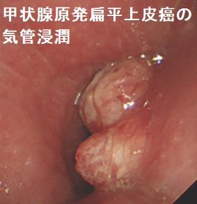 甲状腺原発扁平上皮癌の気管浸潤 気管支鏡 甲状腺原発扁平上皮癌の気管浸潤 気管支鏡