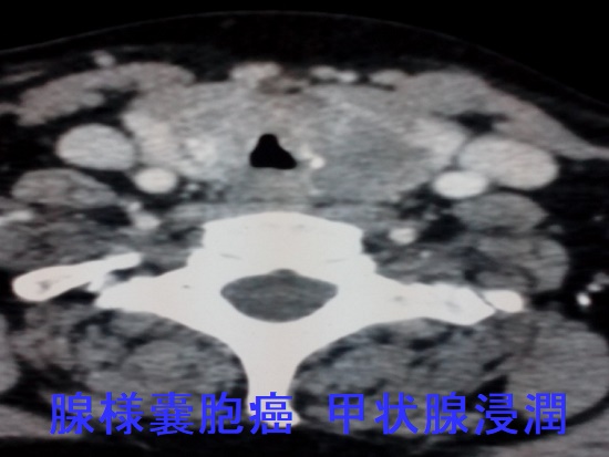 腺様嚢胞癌 甲状腺浸潤 腺様嚢胞癌 甲状腺浸潤