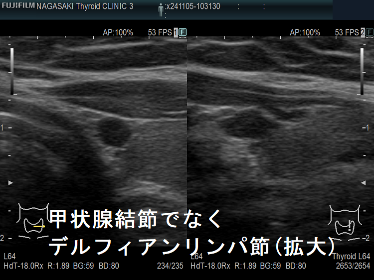 甲状腺結節でなくデルフィアンリンパ節(拡大) 甲状腺結節でなくデルフィアンリンパ節(拡大)