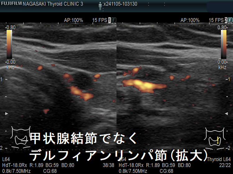 甲状腺結節でなくデルフィアンリンパ節(拡大)ドプラーモード 甲状腺結節でなくデルフィアンリンパ節(拡大)ドプラーモード
