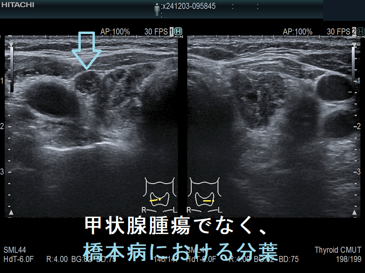 甲状腺腫瘍でなく、橋本病における分葉 甲状腺腫瘍でなく、橋本病における分葉