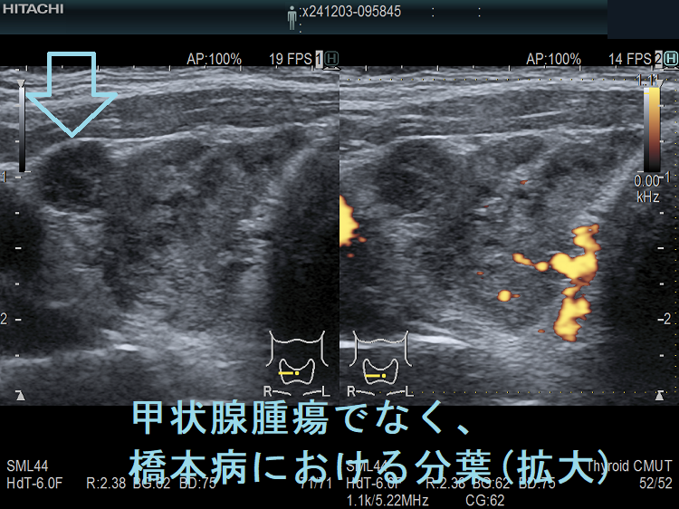 甲状腺腫瘍でなく、橋本病における分葉(拡大) 甲状腺腫瘍でなく、橋本病における分葉(拡大)