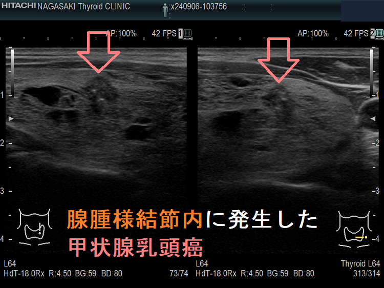 腺腫様結節内に発生した甲状腺乳頭癌 腺腫様結節内に発生した甲状腺乳頭癌