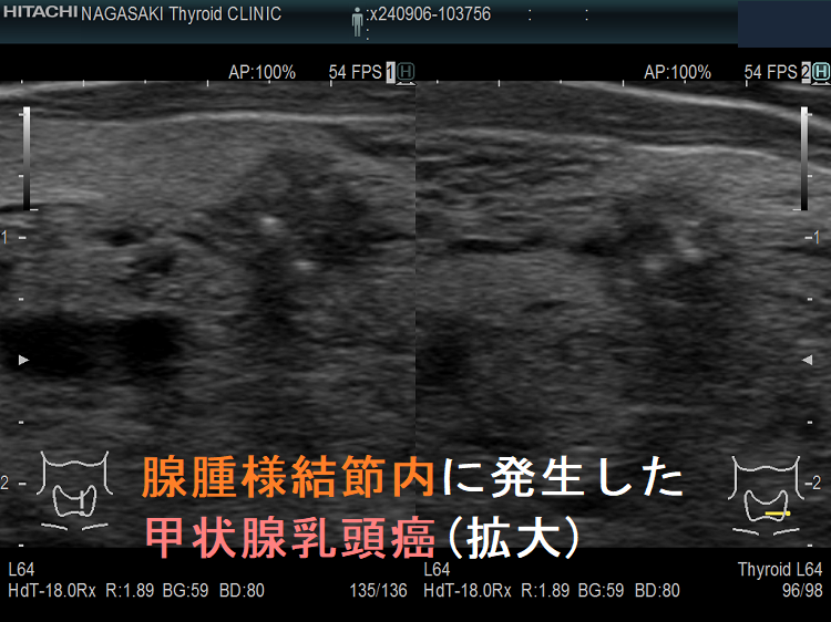 腺腫様結節内に発生した甲状腺乳頭癌(拡大) 腺腫様結節内に発生した甲状腺乳頭癌(拡大)