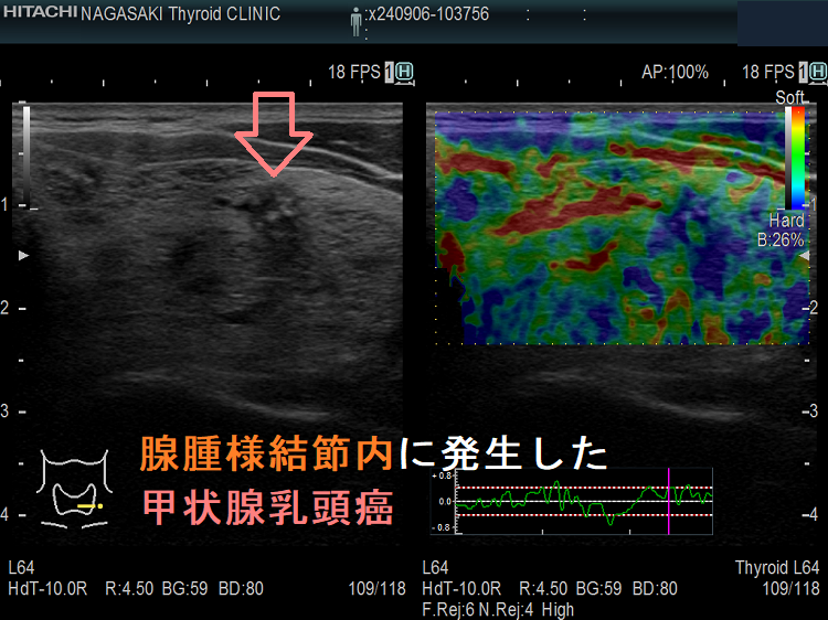 腺腫様結節内に発生した甲状腺乳頭癌 エラストグラフィー 腺腫様結節内に発生した甲状腺乳頭癌 エラストグラフィー