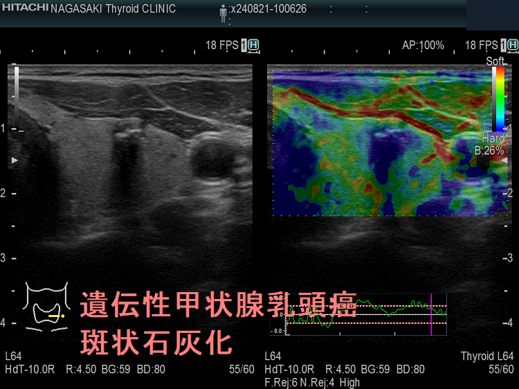 遺伝性甲状腺乳頭癌 斑状石灰化 エラストグラフィー 遺伝性甲状腺乳頭癌 斑状石灰化 エラストグラフィー