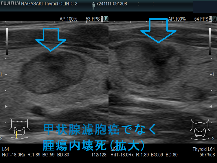 甲状腺濾胞癌でなく腫瘍内壊死(拡大) 甲状腺濾胞癌でなく腫瘍内壊死(拡大)