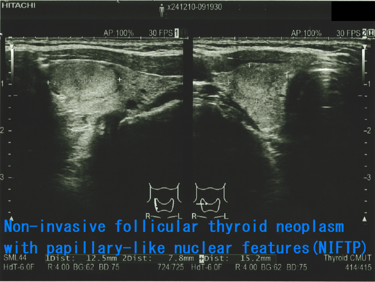 Non-invasive follicular thyroid neoplasm with papillary-like nuclear features (NIFTP)1 Non-invasive follicular thyroid neoplasm with papillary-like nuclear features (NIFTP)1