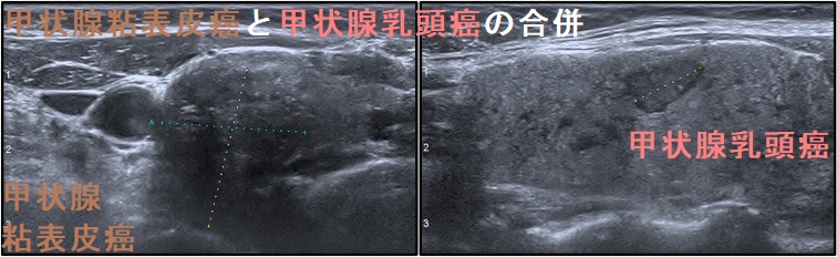 甲状腺粘表皮癌と甲状腺乳頭癌の合併 甲状腺粘表皮癌と甲状腺乳頭癌の合併