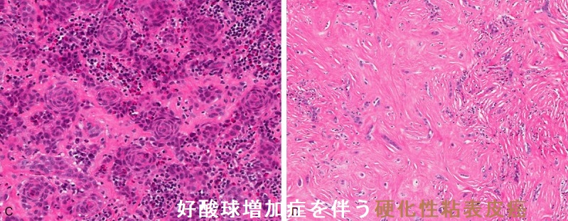 好酸球増加症を伴う硬化性粘表皮癌 好酸球増加症を伴う硬化性粘表皮癌