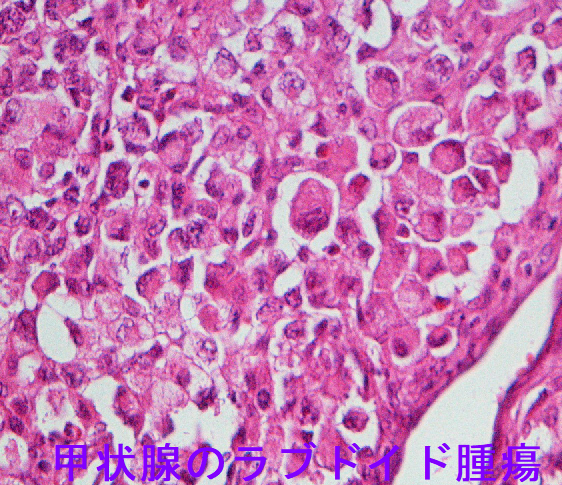 甲状腺のラブドイド腫瘍 甲状腺のラブドイド腫瘍