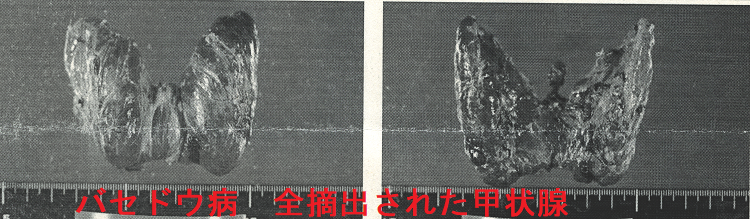 バセドウ病 全摘出された甲状腺 バセドウ病 全摘出された甲状腺