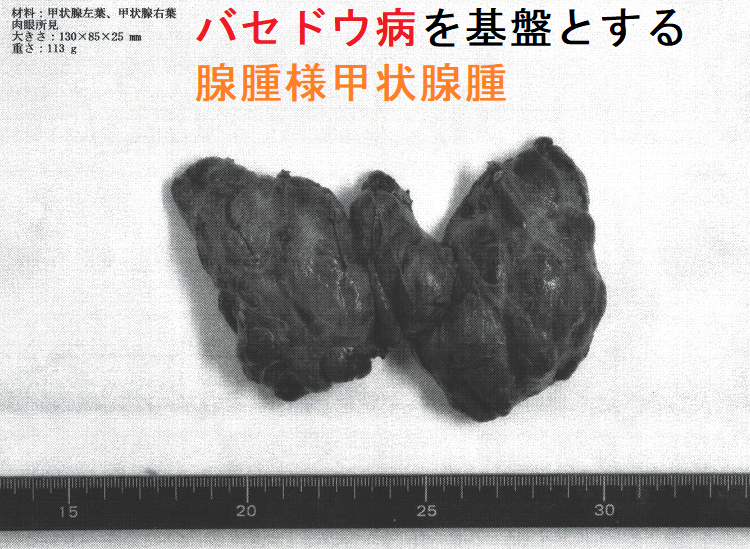 バセドウ病を基盤とする腺腫様甲状腺腫 摘出標本 バセドウ病を基盤とする腺腫様甲状腺腫 摘出標本