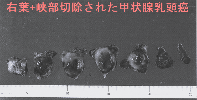右葉+峡部切除された甲状腺乳頭癌 右葉+峡部切除された甲状腺乳頭癌