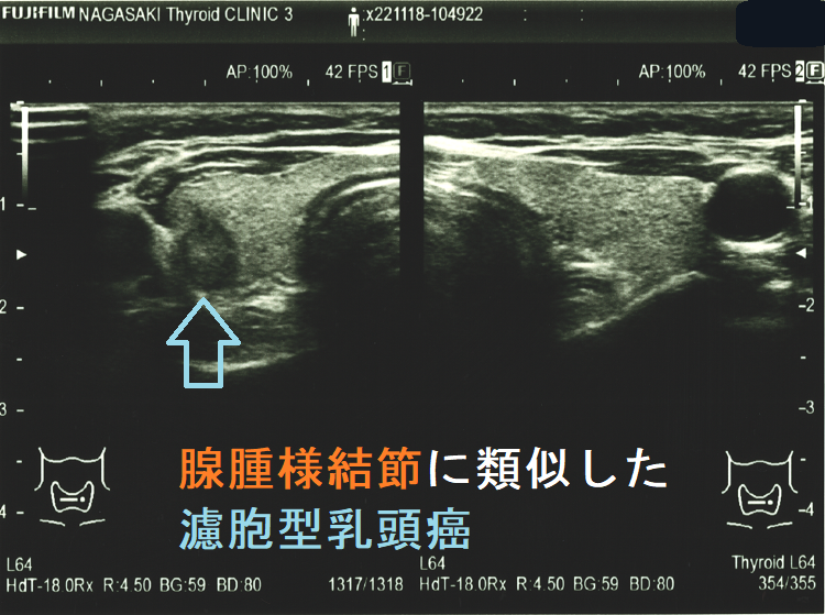 腺腫様結節に類似した濾胞型乳頭癌2 腺腫様結節に類似した濾胞型乳頭癌2