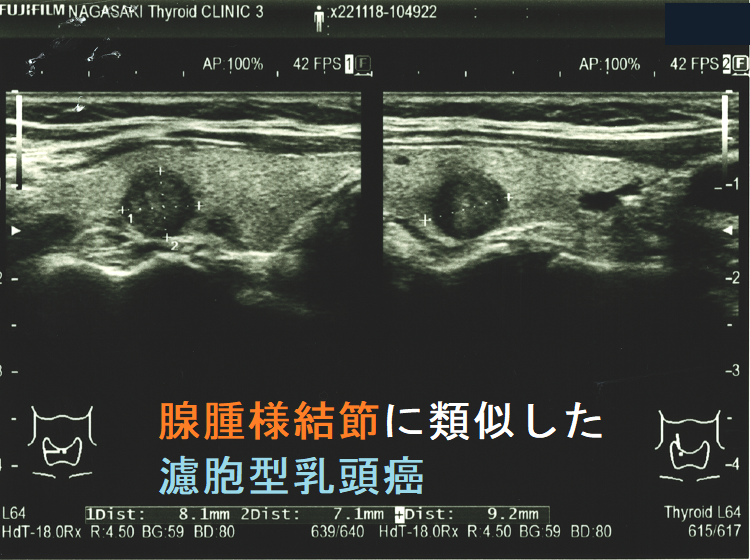腺腫様結節に類似した濾胞型乳頭癌1 腺腫様結節に類似した濾胞型乳頭癌1