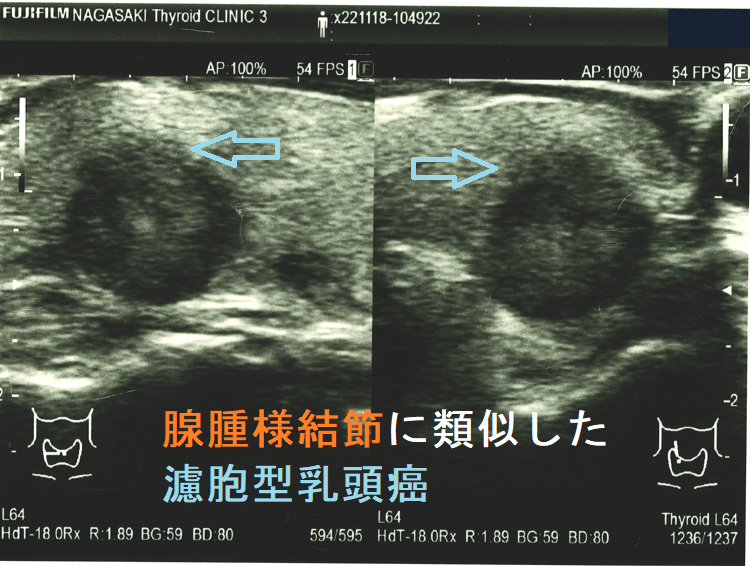 腺腫様結節に類似した濾胞型乳頭癌3 腺腫様結節に類似した濾胞型乳頭癌3
