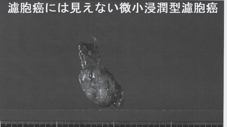 甲状腺癌に見えるが、濾胞癌には見えない微小浸潤型濾胞癌 手術標本 甲状腺癌に見えるが、濾胞癌には見えない微小浸潤型濾胞癌 手術標本