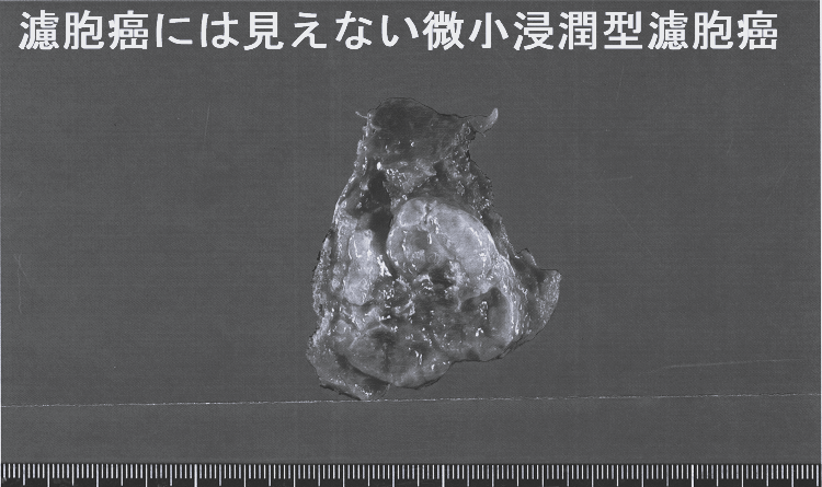 甲状腺濾胞癌には見えない微小浸潤型濾胞癌 手術標本 甲状腺濾胞癌には見えない微小浸潤型濾胞癌 手術標本