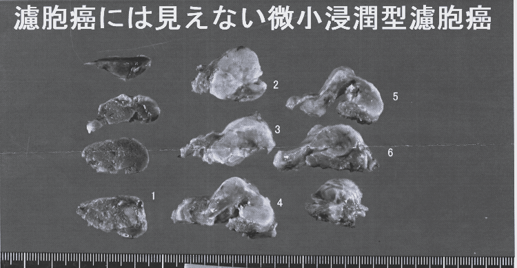 濾胞癌には見えない微小浸潤型濾胞癌 手術標本(割面) 濾胞癌には見えない微小浸潤型濾胞癌 手術標本(割面)