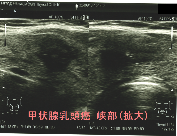 峡部に発生した甲状腺乳頭癌(拡大) 峡部に発生した甲状腺乳頭癌(拡大)