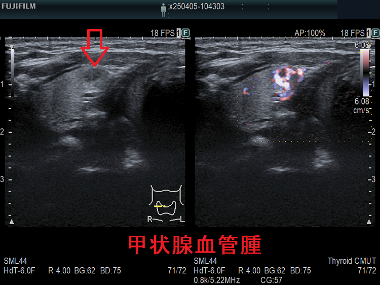 甲状腺血管腫 超音波(エコー)画像 eFlow モード 甲状腺血管腫 超音波(エコー)画像 eFlow モード