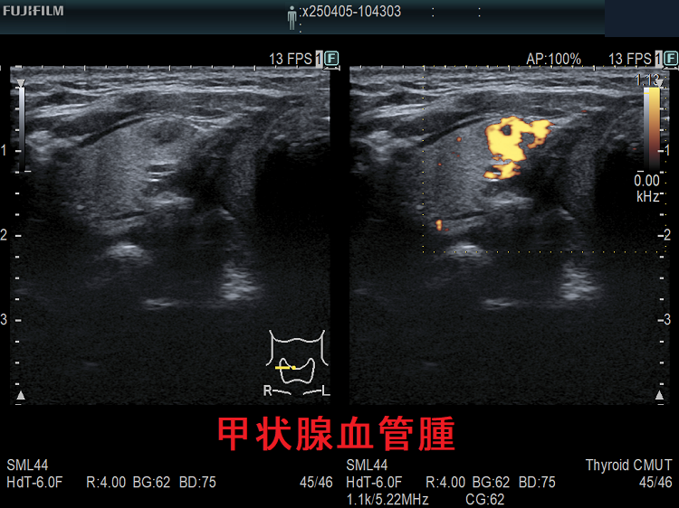 甲状腺血管腫 超音波(エコー)画像 パワードプラーモード 甲状腺血管腫 超音波(エコー)画像 パワードプラーモード