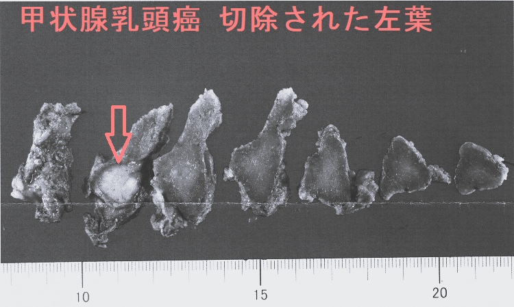 甲状腺乳頭癌 切除された左葉 甲状腺乳頭癌 切除された左葉