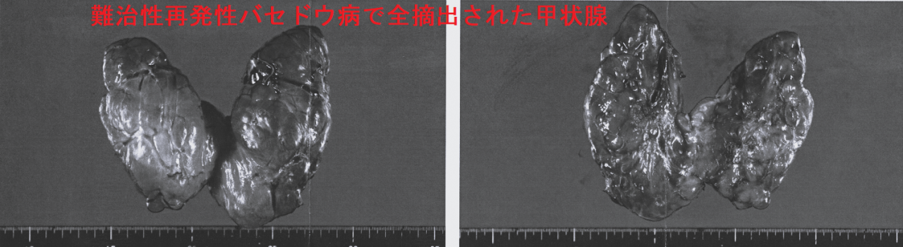 難治性再発性バセドウ病で全摘出された甲状腺 難治性再発性バセドウ病で全摘出された甲状腺