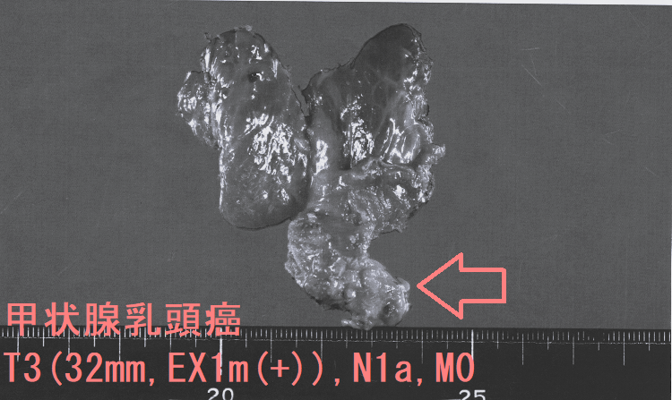 甲状腺乳頭癌 T3(32mm,EX1m(+)),N1a,M0 甲状腺乳頭癌 T3(32mm,EX1m(+)),N1a,M0