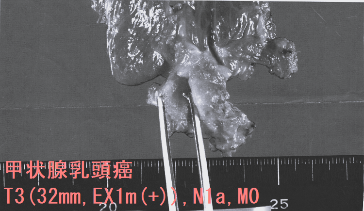 甲状腺乳頭癌の治療 外科手術;甲状腺全摘出,甲状腺片葉切除,予防