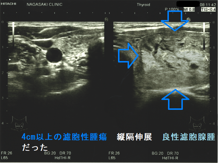 4cm以上の濾胞性腫瘍 縦隔伸展 良性濾胞腺腫だった 4cm以上の濾胞性腫瘍 縦隔伸展 良性濾胞腺腫だった