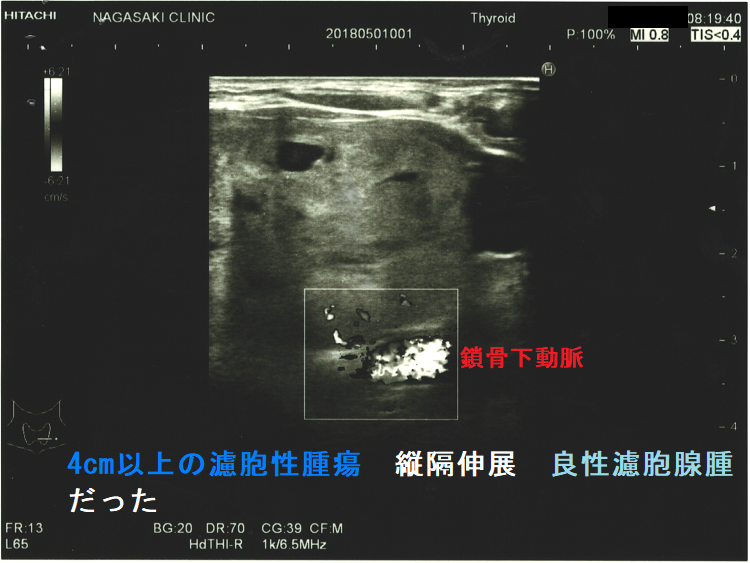 4cm以上の濾胞性腫瘍 縦隔伸展 良性濾胞腺腫だった2 4cm以上の濾胞性腫瘍 縦隔伸展 良性濾胞腺腫だった2