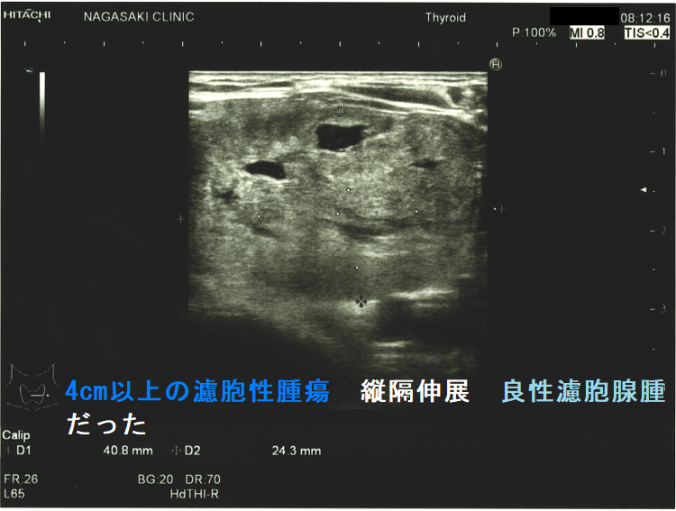 4cm以上の濾胞性腫瘍 縦隔伸展 良性濾胞腺腫だった(水平断) 4cm以上の濾胞性腫瘍 縦隔伸展 良性濾胞腺腫だった(水平断)
