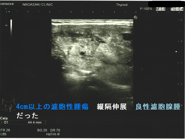 4cm以上の濾胞性腫瘍 縦隔伸展 良性濾胞腺腫だった(矢状断) 4cm以上の濾胞性腫瘍 縦隔伸展 良性濾胞腺腫だった(矢状断)